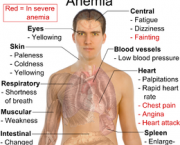 anemia-4
