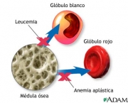 anemia-9