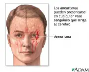 aneurisma-cerebral-1