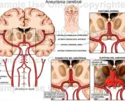 aneurisma-cerebral-12