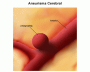 aneurisma-cerebral-13