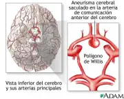 aneurisma-cerebral-2