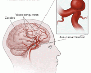 aneurisma-cerebral-5