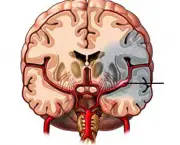 aneurisma-cerebral-6