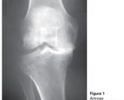 artrose-no-joelho-5