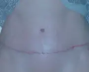 Cicatriz de Abdominoplastia (10)