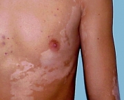 como-e-classificado-o-vitiligo-1