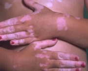 como-e-classificado-o-vitiligo-3
