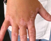 como-o-vitiligo-evolui-e-e-uma-doenca-comum-1