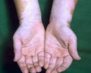 como-o-vitiligo-evolui-e-e-uma-doenca-comum-2