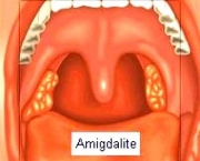 como-tratar-a-amigdalite-19
