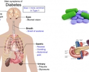 Diabetes Insipidus (11)