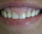 Prótese Dentária de Silicone Fixa (8)
