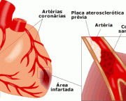 qual-o-significado-de-infarto-do-miocardio-2