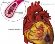 qual-o-significado-de-infarto-do-miocardio-3