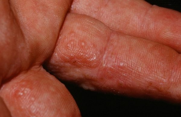 Disidrose nos Dedos