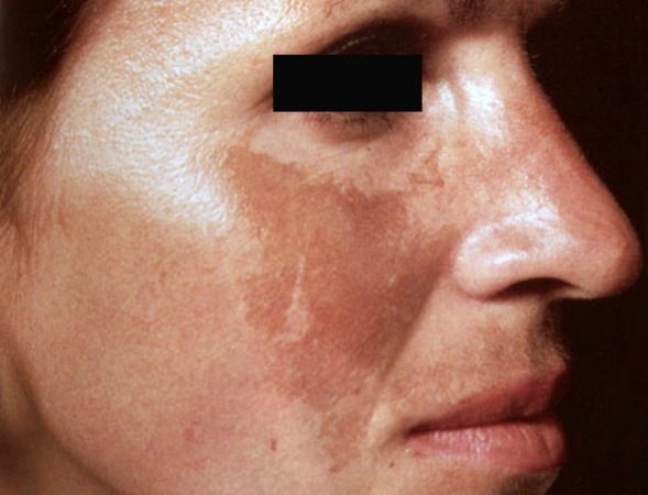 Melasma