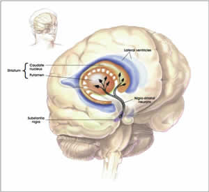 A Doença de Parkinson