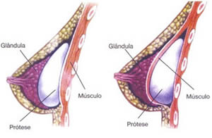 Medicina da Mamoplastia