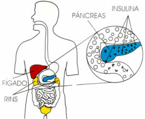 Tipos de Diabetes