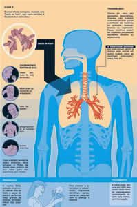 Tuberculose