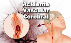AVC AVC