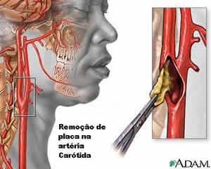 Acidente Vascular Cerebral Isquemica