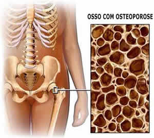 Osteoporose