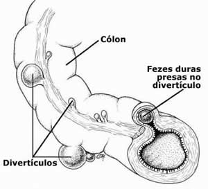 Diverticulite