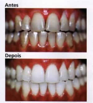 Clareamento Dental