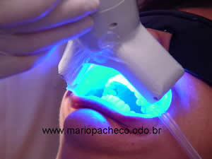 Clareamento Dental a Laser Clareamento Dental a Laser