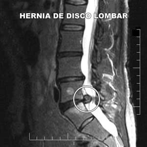 hernia-1 Lombar