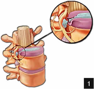 hernia-3 Cirurgia