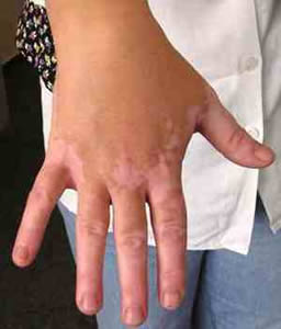 vitiligo-2 Cura