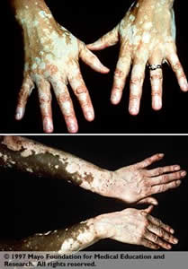 Vitiligo