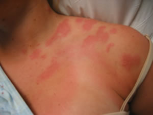 Herpes Zoster Herpes Zoster