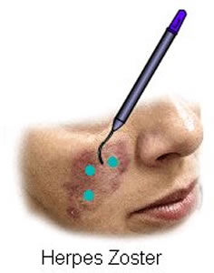 herpes-2 Tratamento