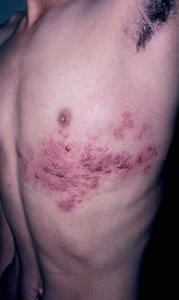herpes-3 Herpes Zoster