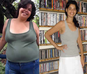 Cirurgia Bariátrica Cirurgia Bariátrica