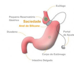 Redução de Estomago