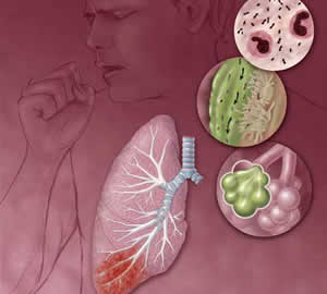 Causas Pneumonia