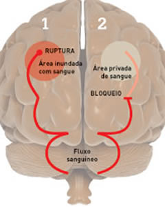 avc-2 Tratamento