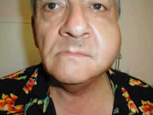 Caxumba na Gravidez Sintomas