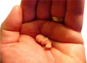 Caxumba na Gravidez Aborto