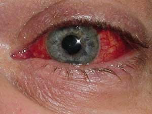 Conjuntivite Viral Sintomas