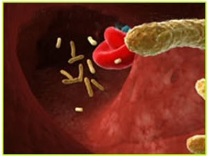 Hanseníase Tuberculóide