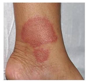 hanseniase-tuberculoide-3 Doença