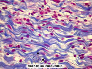 hanseniase-virchowiana-2 Hanseníase Virchowiana