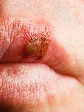 Herpes Herpes