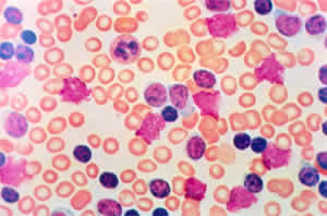 leucemia-1 Linfocitica